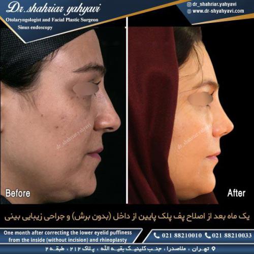 جراحی بینی 451