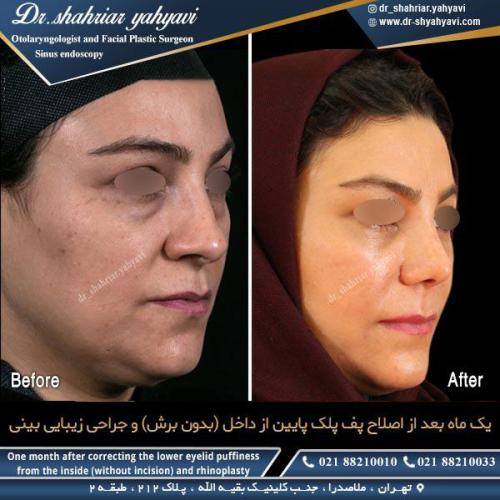 جراحی بینی 452