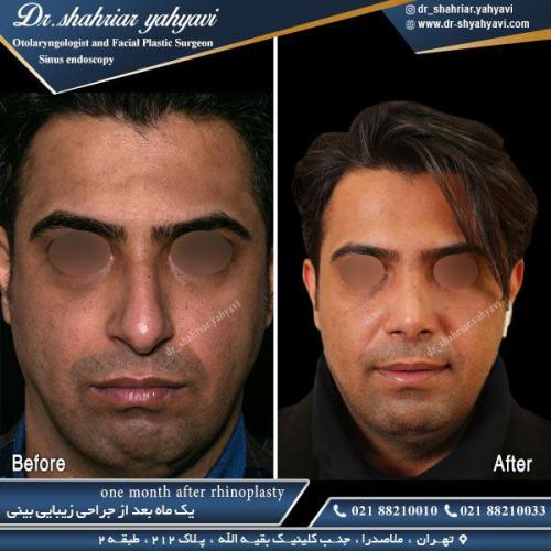 جراحی بینی 453