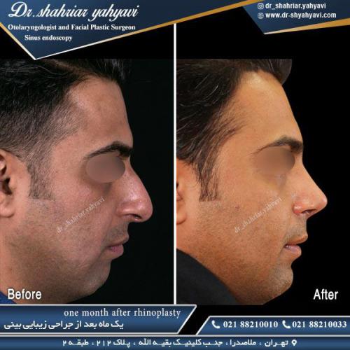 جراحی بینی 454