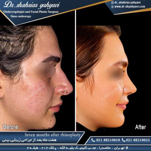 جراحی بینی 455