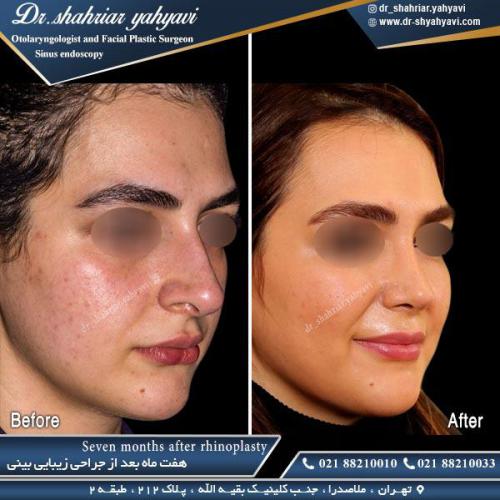 جراحی بینی 456