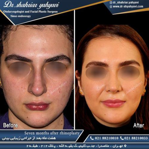 جراحی بینی 457