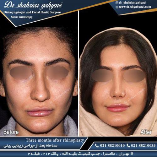 جراحی بینی 458