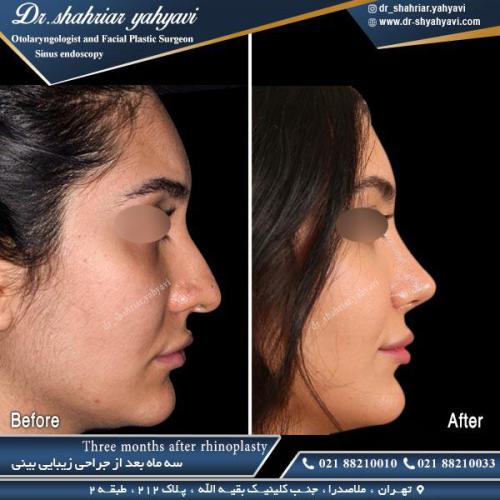 جراحی بینی 459