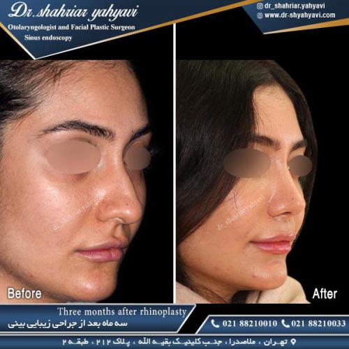 جراحی بینی 460