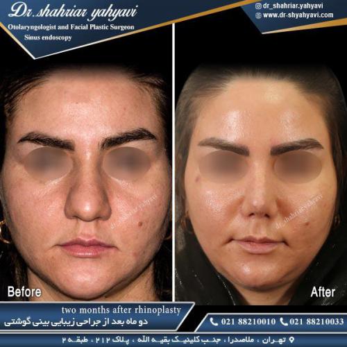 جراحی بینی 461