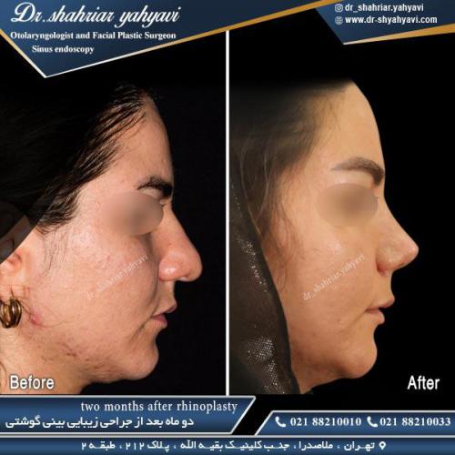 جراحی بینی 462