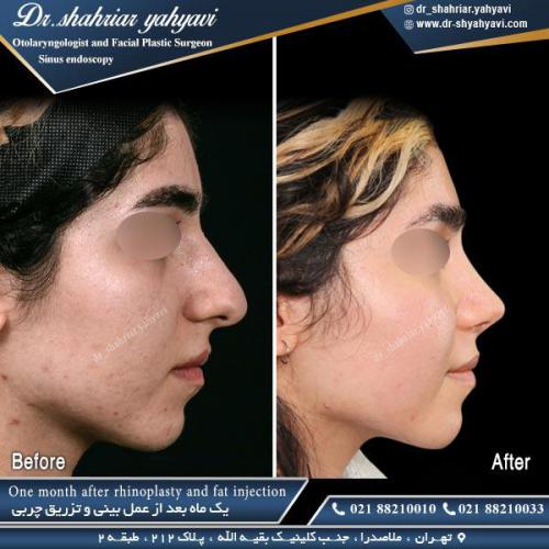 جراحی بینی 463