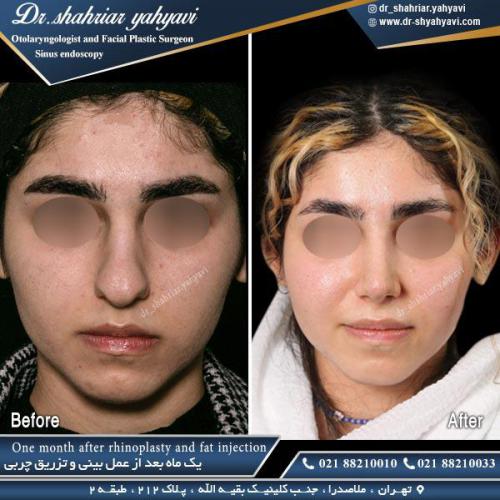 جراحی بینی 464