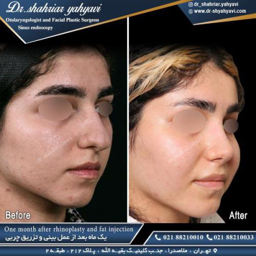 جراحی بینی 465