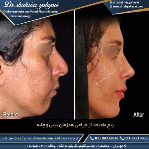 جراحی بینی 466