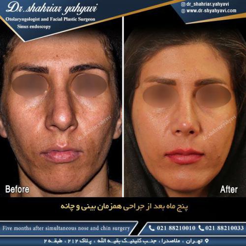 جراحی بینی 467