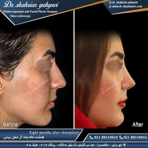 جراحی بینی 468