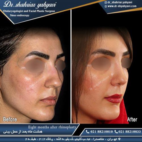 جراحی بینی 469