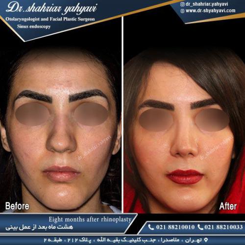 جراحی بینی 470