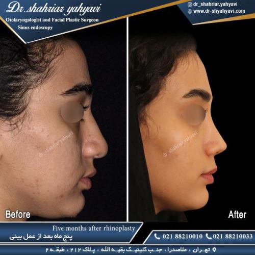 جراحی بینی 471