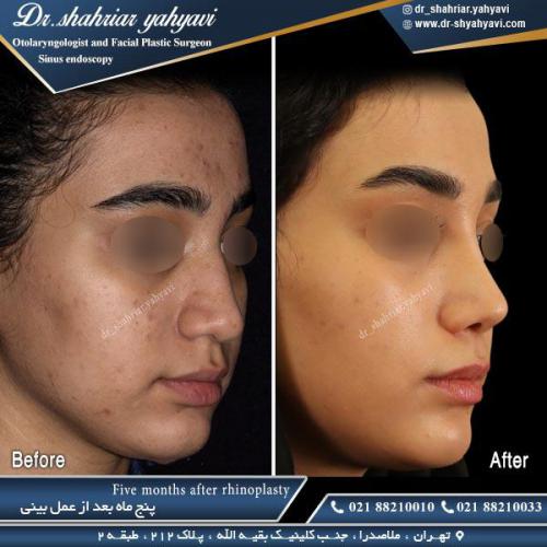 جراحی بینی 472