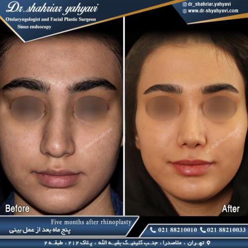جراحی بینی 473-1