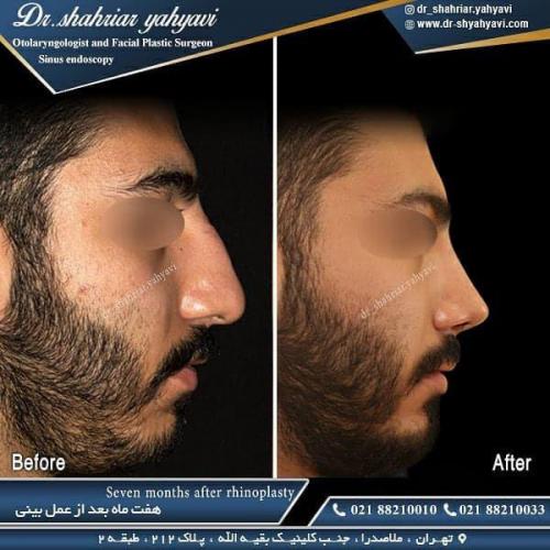 جراحی بینی 474