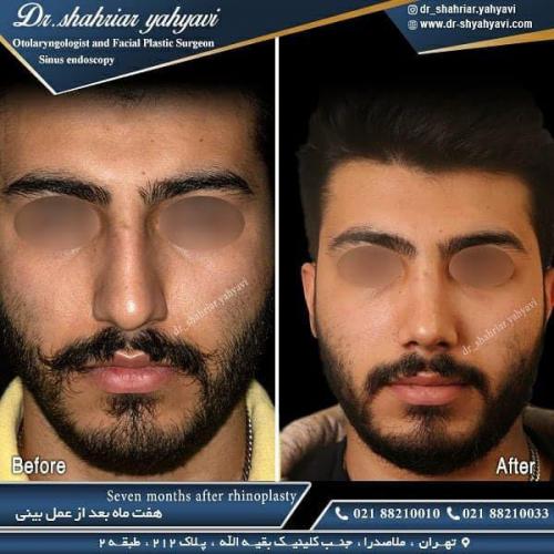 جراحی بینی 475