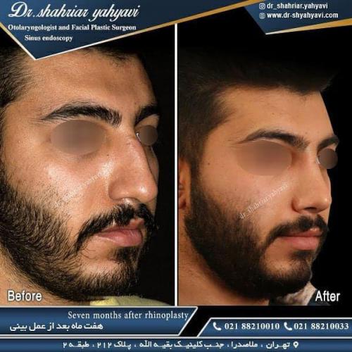 جراحی بینی 476