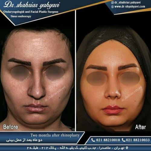جراحی بینی 477