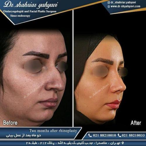 جراحی بینی 478