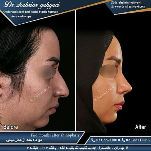 جراحی بینی 479