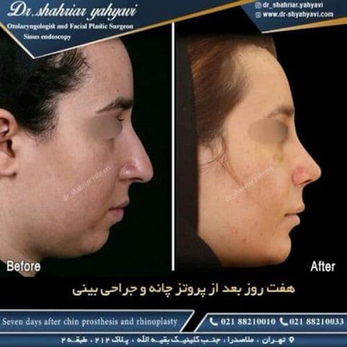 جراحی بینی 480