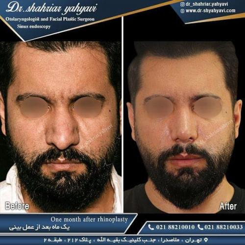 جراحی بینی 481