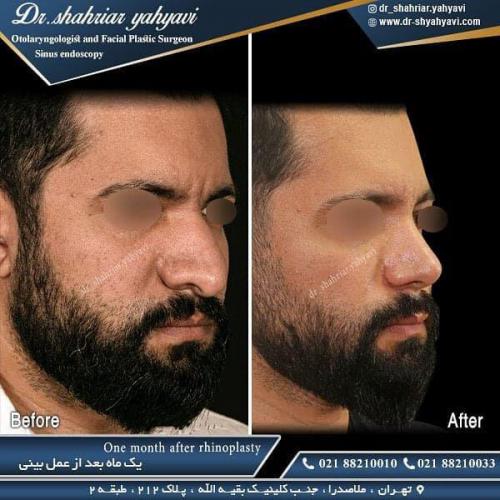 جراحی بینی 482