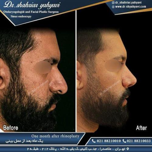 جراحی بینی 483