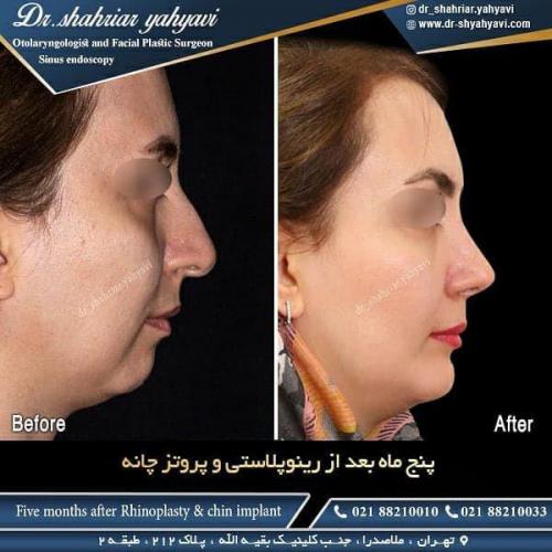 جراحی بینی 484