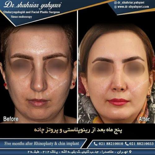 جراحی بینی 485