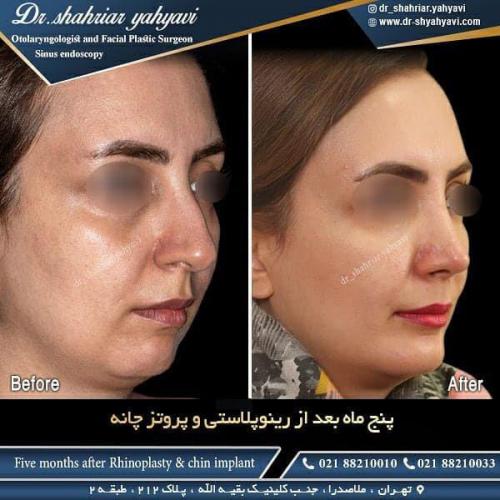 جراحی بینی 486