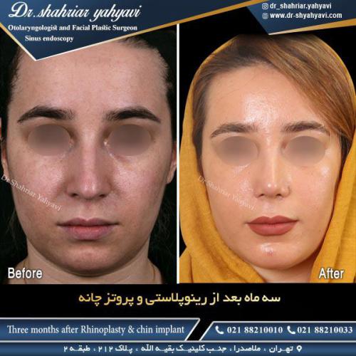 جراحی بینی 487