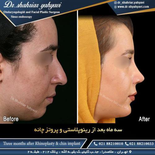 جراحی بینی 488