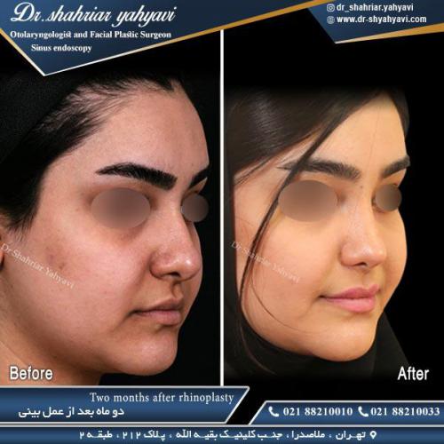 جراحی بینی 489
