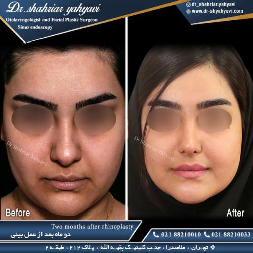 جراحی بینی 490