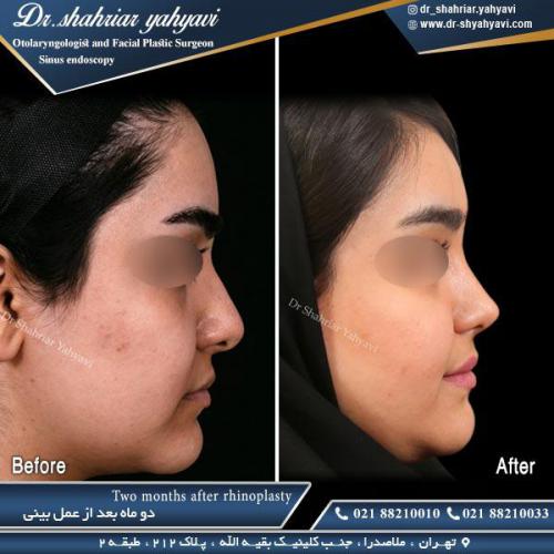 جراحی بینی 491