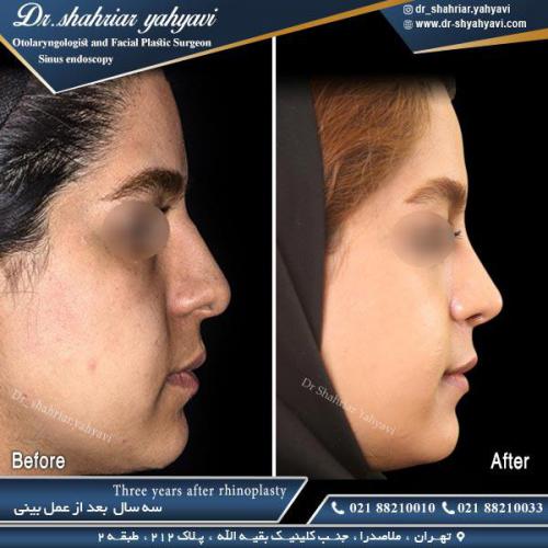 جراحی بینی 492