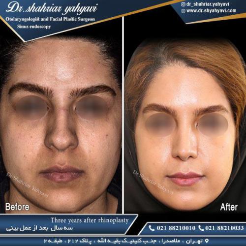 جراحی بینی 493