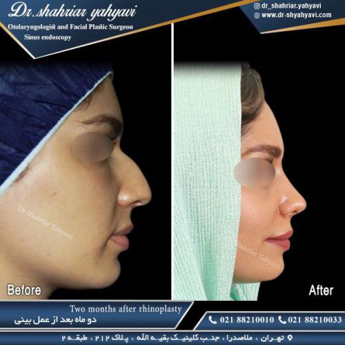 جراحی بینی 494