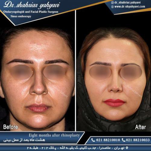 جراحی بینی 496