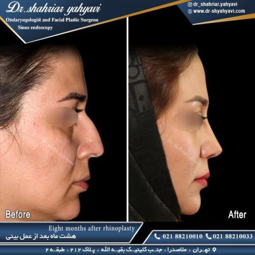جراحی بینی 497