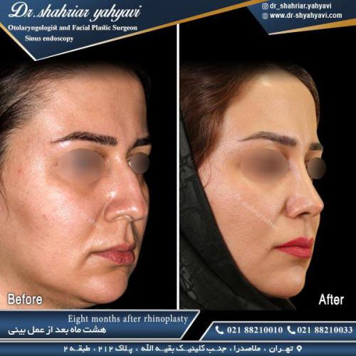 جراحی بینی 498