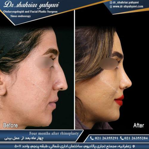 جراحی بینی 499