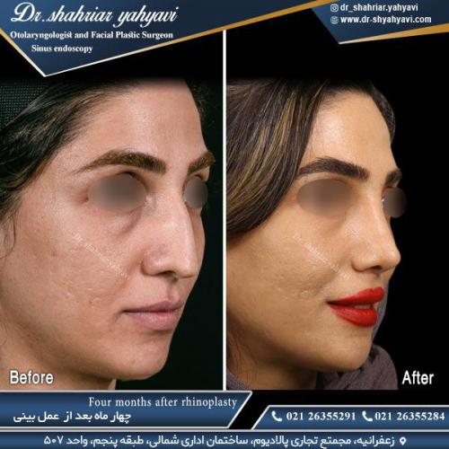 جراحی بینی 500