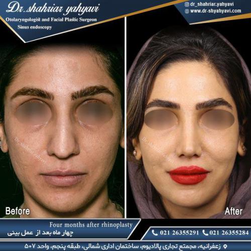 جراحی بینی 501